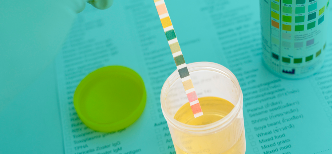 O que a cor da urina pode dizer sobre a saúde do rim?