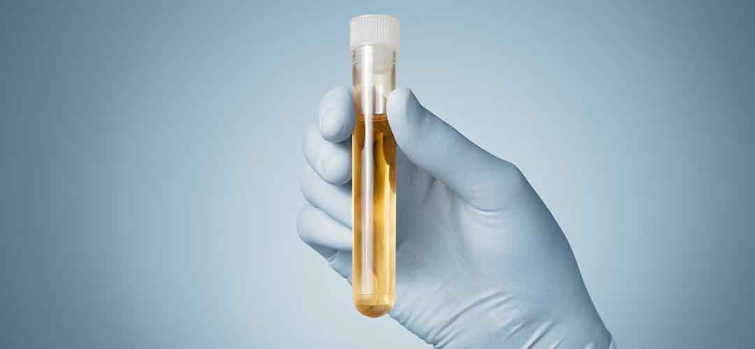 O câncer de rim é detectável pelo exame de urina?