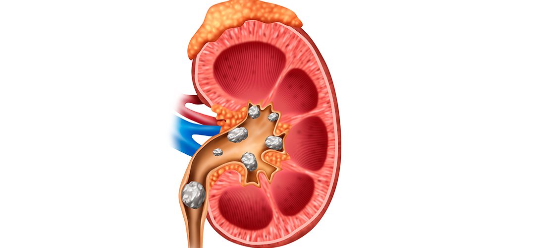 Pedra no rim, cálculo ou litíase renal