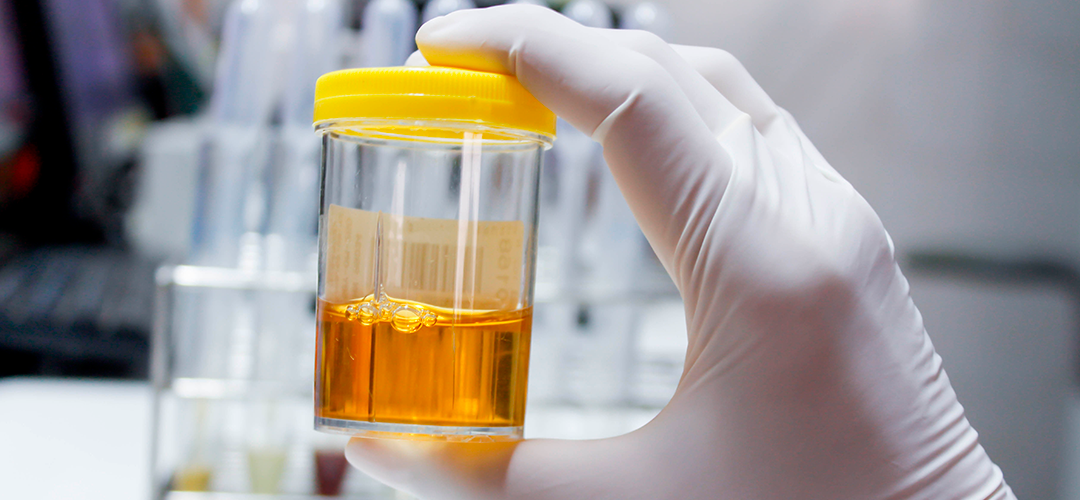 Proteína na urina (proteinúria): o que pode ser?