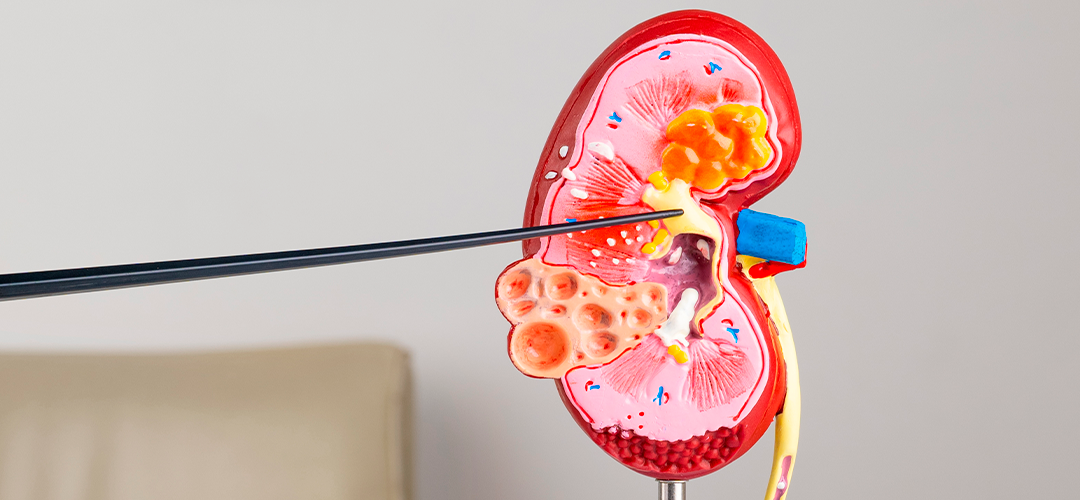 Rins policísticos: causas, sintomas e tratamentos