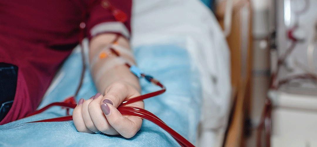 O que é fístula para hemodiálise?