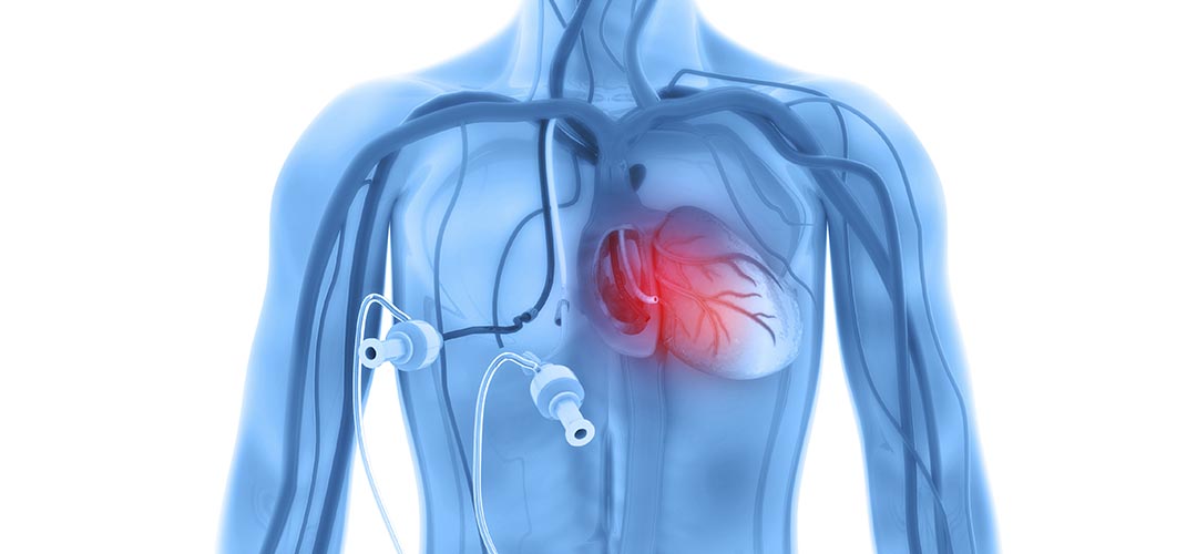 Tudo sobre a hemodiálise cardioprotetora (HDF) e para quem é indicada