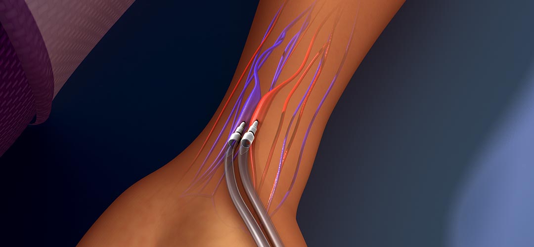 Qual é a diferença entre hemodiafiltração (HDF) e hemodiálise?